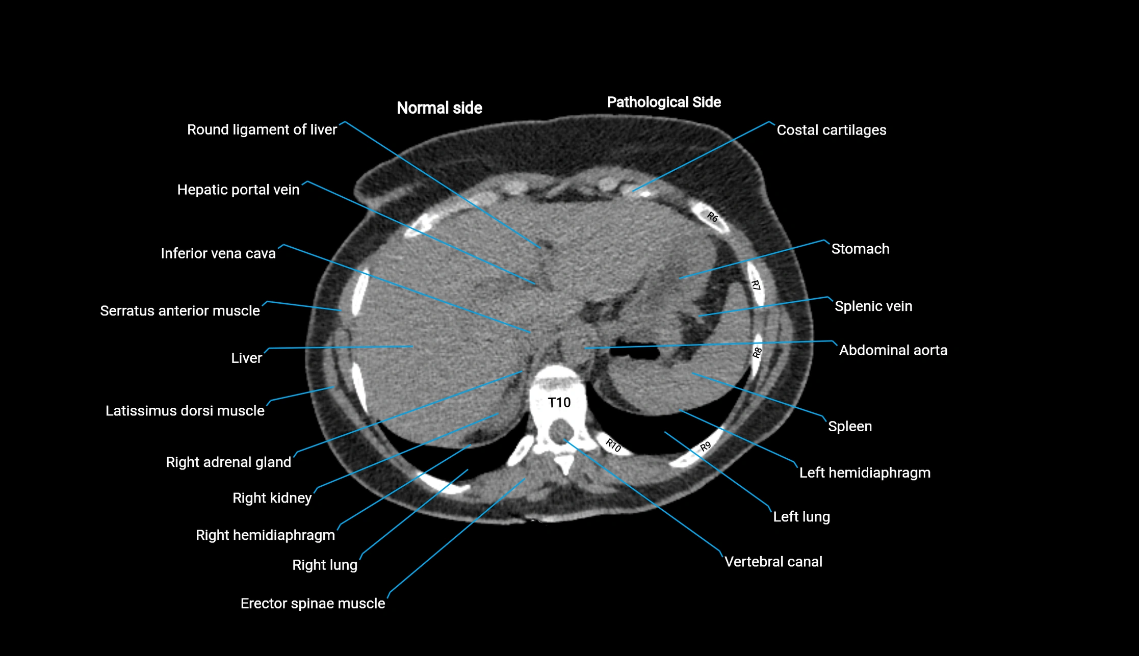 CT KUB axial cross sectional anatomy  radiology image -img-00201-00010.webp